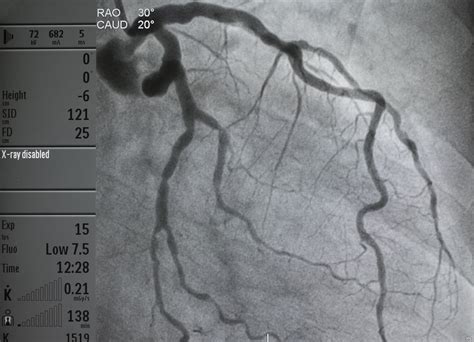 Coronary Angiography .